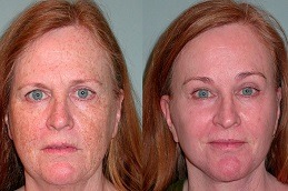 Laser Photo Rejuvenation Clinic in Dubai