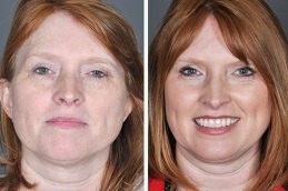 Laser Photo Rejuvenation Dubai & Abu Dhabi