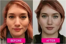 Lip Enlargement Clinic in Abu Dhabi