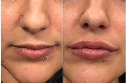 Lip Enlargement Clinic in Dubai
