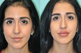 Lip Enlargement Dubai & Abu Dhabi