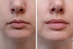 Lip Enlargement in Dubai Abu Dhabi