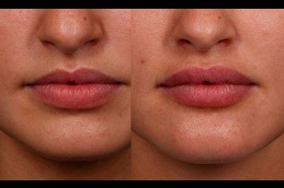 Lip Enlargement in Dubai