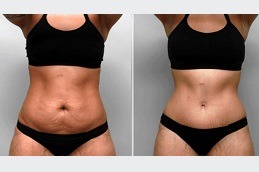 Lipolysis Treatment Abu Dhabi