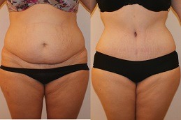 Lipolysis Treatment Dubai