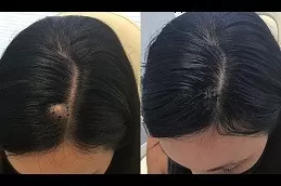 Lipoma Treatment in Dubai