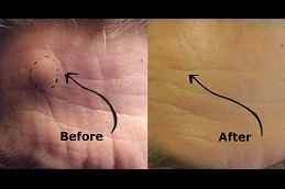 Lipoma Treatment Dubai