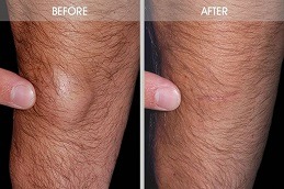 Lipoma Treatment