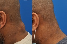 Best Lipoma Treatment in Dubai