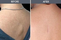Best Lipoma Treatment Dubai