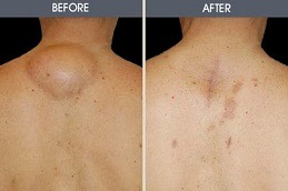 Lipoma Treatment