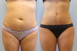 Lipomatic Treatment Clinic in Abu Dhabi