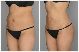 Lipomatic Treatment Clinic in Dubai