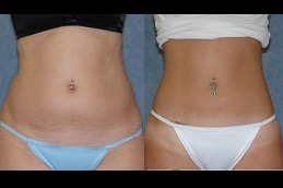 Lipomatic Treatment in Dubai & Abu Dhabi
