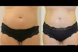 Liposonix Treatment Clinic Dubai & Abu Dhabi