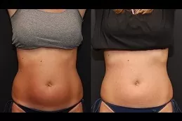 Liposonix Treatment Clinic Dubai