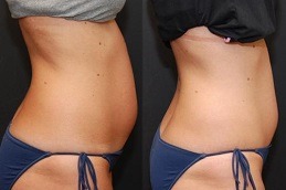 Liposonix Treatment Dubai Abu Dhabi