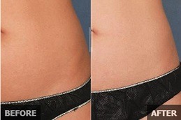 Liposonix Treatment in Dubai & Abu Dhabi