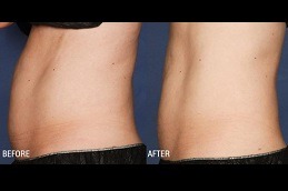 Liposonix Treatment in Dubai