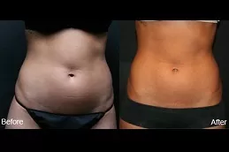 Liposonix Treatment