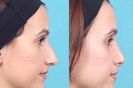 Liquid Rhinoplasty Clinic in Dubai