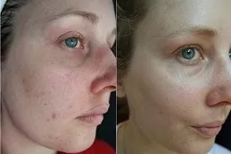 Micro-needling with PRP Therapy Abu Dhabi