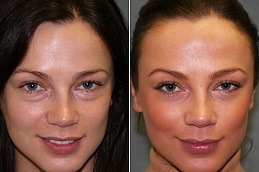 Micro-needling with PRP Therapy Clinic Abu Dhabi