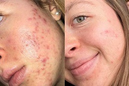 Micro-needling with PRP Therapy Clinic Dubai