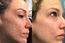 Micro-needling with PRP Therapy Dubai