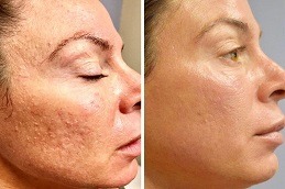 Micro-needling with PRP Therapy in Abu Dhabi