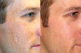 Micro-needling with PRP Therapy in Dubai