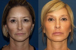 Neck Lift Surgery in Dubai