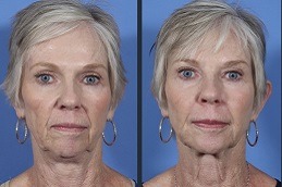 Neck Lift Surgery Dubai