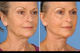 Neck Lift Surgery in Dubai
