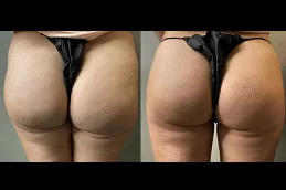 Non Surgical Bum Lift Abu Dhabi