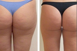 Non Surgical Bum Lift Clinic Abu Dhabi