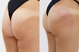 Non Surgical Bum Lift Clinic Dubai
