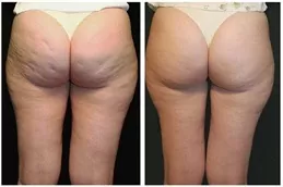 Non Surgical Bum Lift in Abu Dhabi