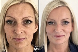 Non-Surgical Facelift Clinic in Abu Dhabi
