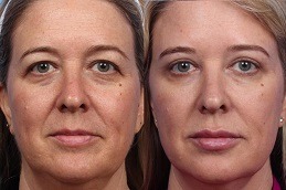 Non-Surgical Facelift Clinic in Dubai