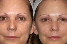 Non-Surgical Facelift in Abu Dhabi