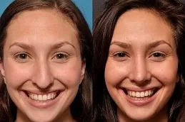 Nose Tip Plasty Dubai & Abu Dhabi