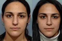 Nose Tip Plasty Dubai