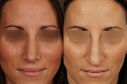 Nose Tip Plasty clinic in dubai