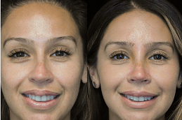 Nose Tip Plasty in Abu Dhabi