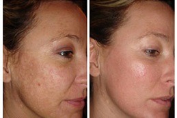 PCA Peel Treatment Clinic Abu Dhabi