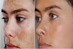 PCA Peel Treatment Clinic Dubai