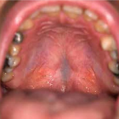 Palate Repair Surgery in Dubai, Abu Dhabi & Sharjah Cleft Palate Surgery