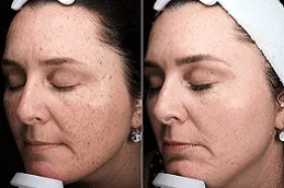 Pico Laser Treatment in Dubai