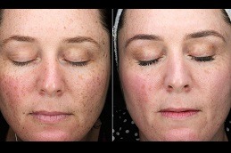 Pico Laser Treatment Dubai